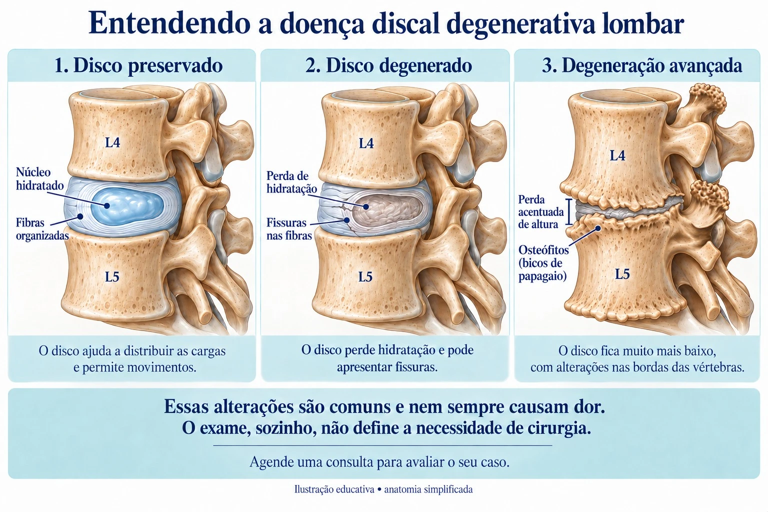Ilustração de doença discal degenerativa lombar