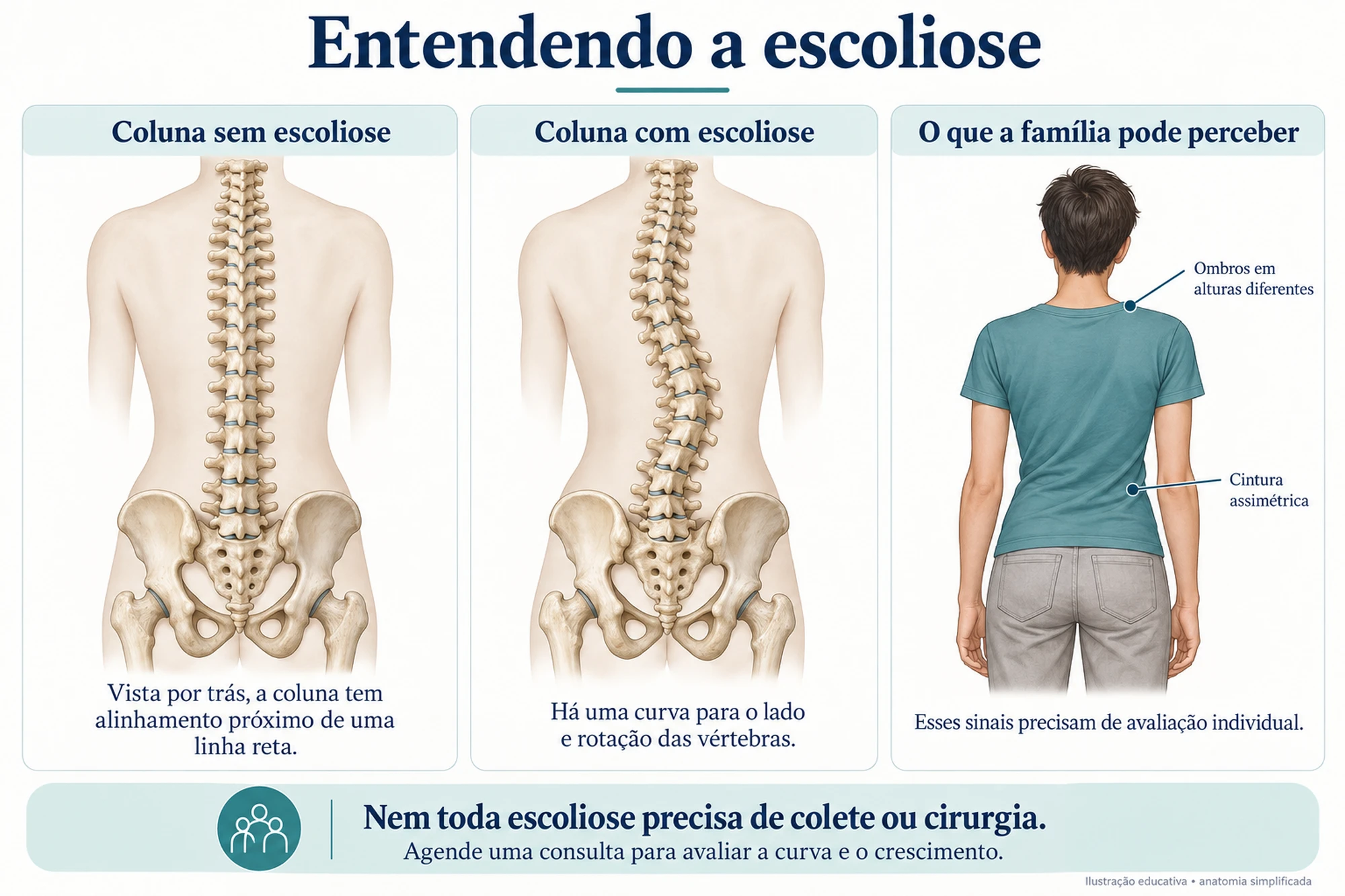 Ilustração de escoliose