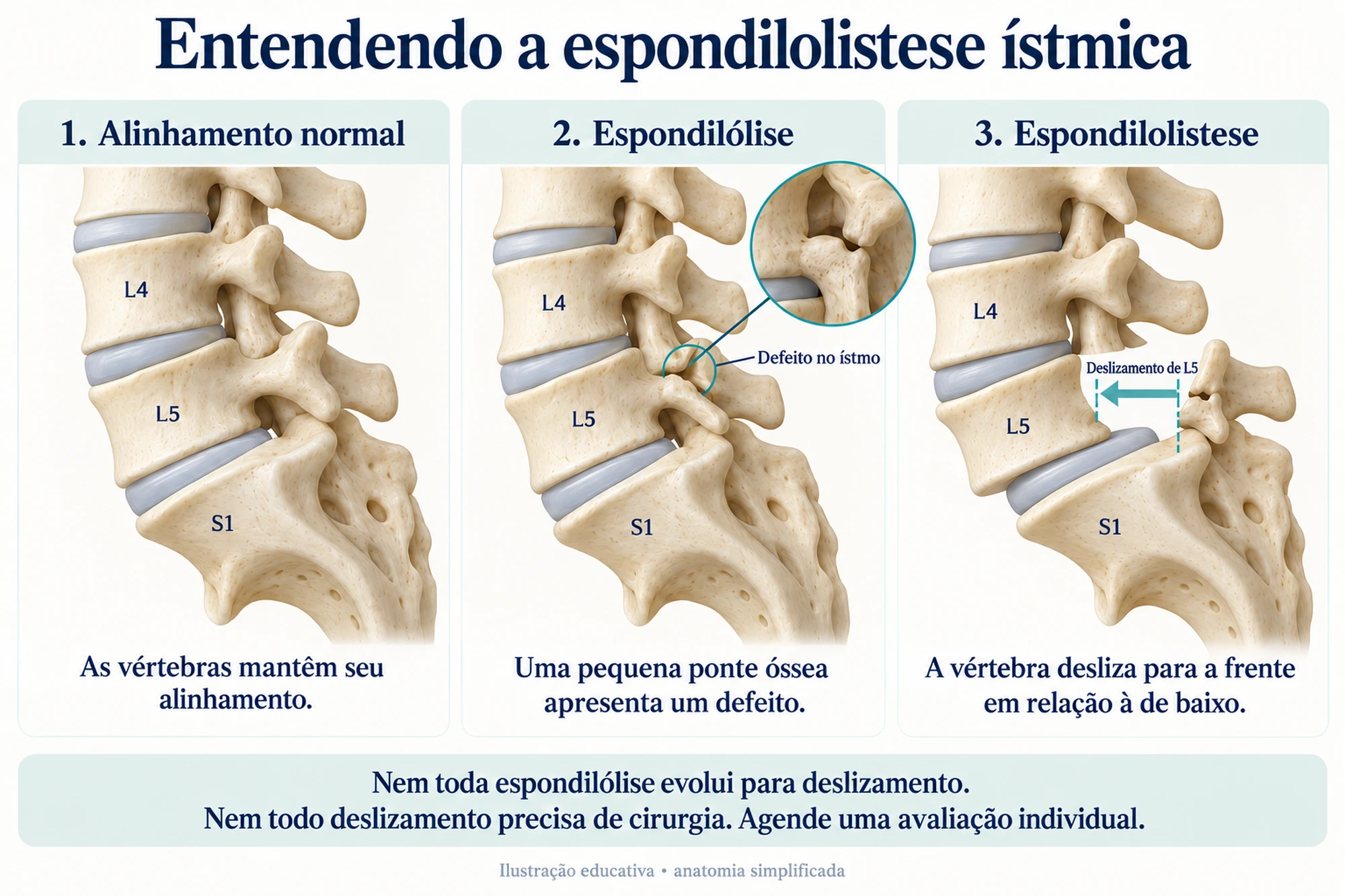 Ilustração de espondilolistese ístmica