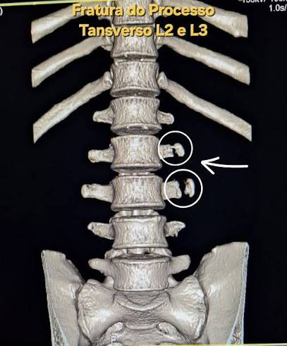 Tomografia 3D com fratura do processo transverso