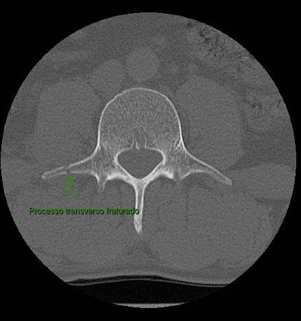 Corte axial de tomografia de uma vértebra lombar, com seta indicando o processo transverso fraturado.