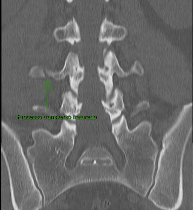 Corte coronal de tomografia da coluna lombar, com seta indicando o processo transverso fraturado.