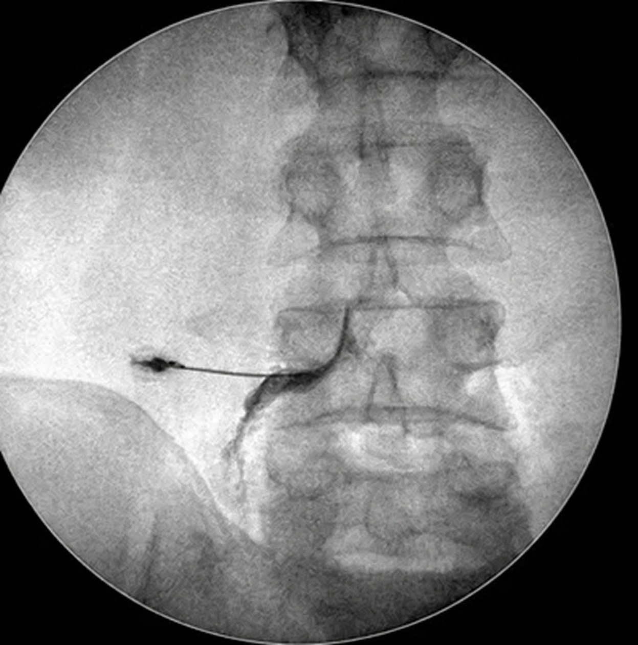 Imagem de radioscopia da coluna lombar durante um bloqueio: a agulha entra pela lateral e o contraste desenha o caminho do medicamento junto à região tratada.