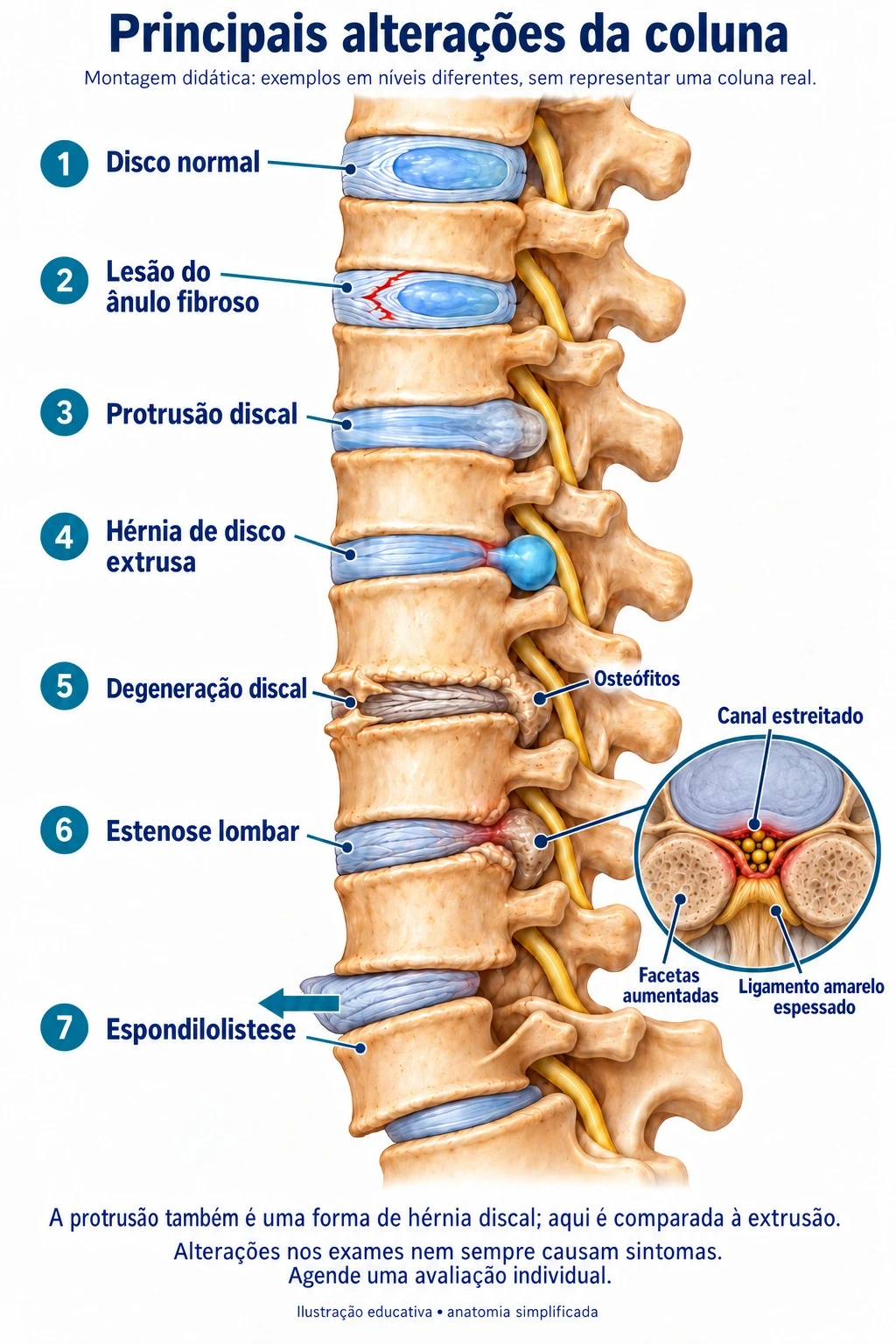 Montagem didática com sete exemplos de alterações da coluna lombar, em níveis diferentes: 1 disco normal, 2 lesão do ânulo fibroso, 3 protrusão discal, 4 hérnia de disco extrusa, 5 degeneração discal com osteófitos, 6 estenose lombar com detalhe do canal estreitado e 7 espondilolistese.