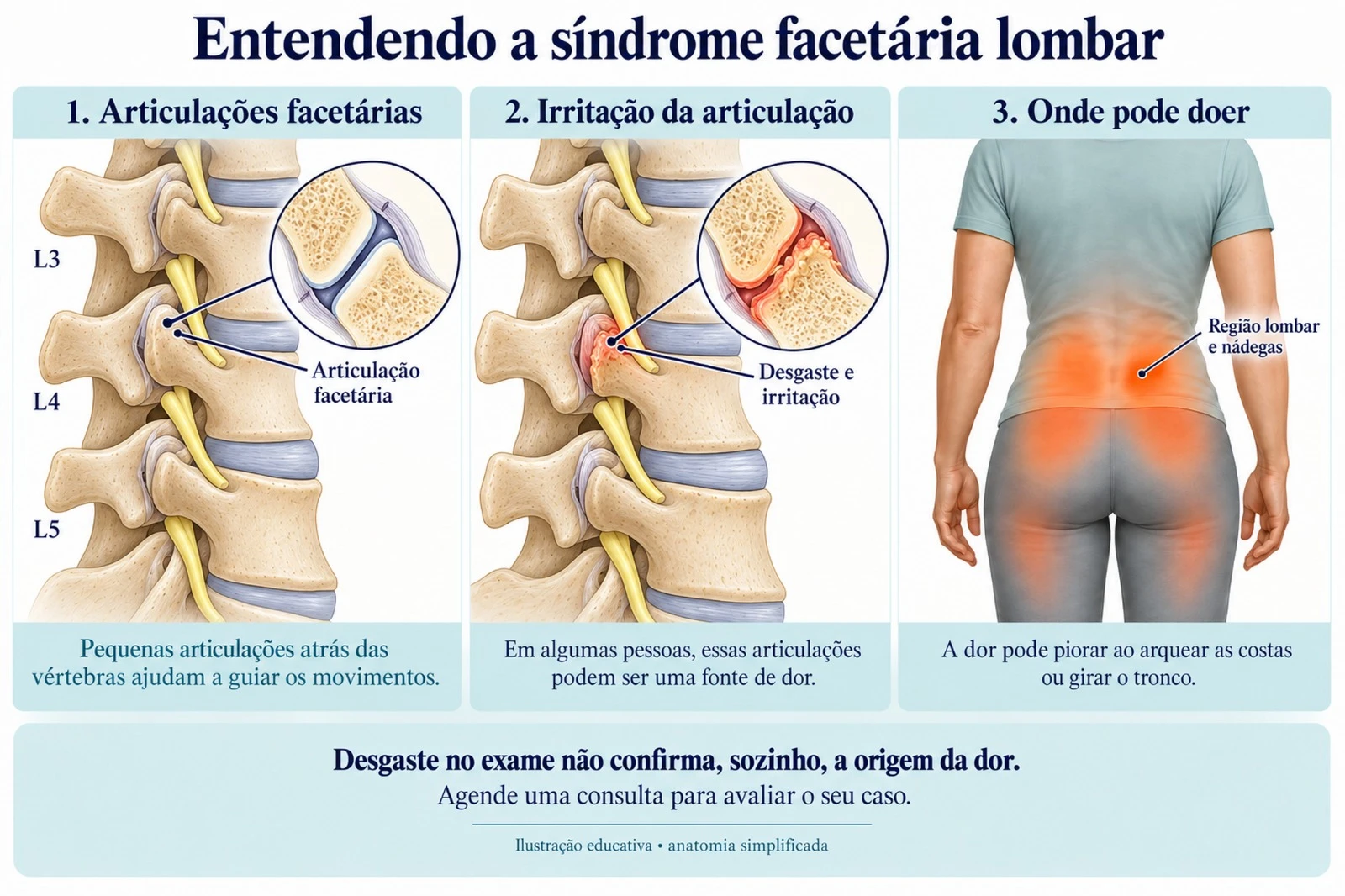Ilustração de síndrome facetária lombar